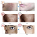Wrinkle Removal LED Mask